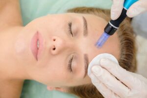 Tulsa Microneedling