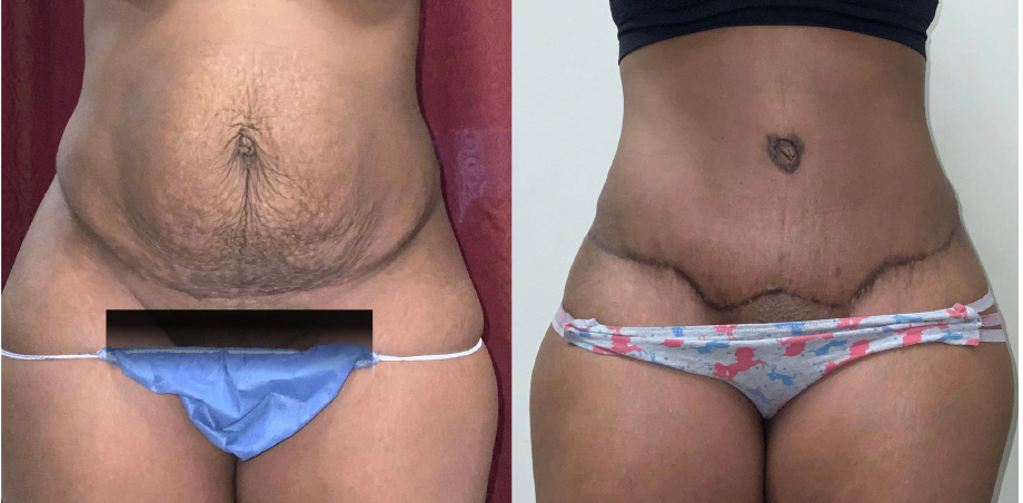 Whitlock Cosmetic Ba Tummy Tuck Patient 5