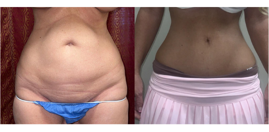 Whitlock Cosmetic Ba Tummy Tuck Patient 6