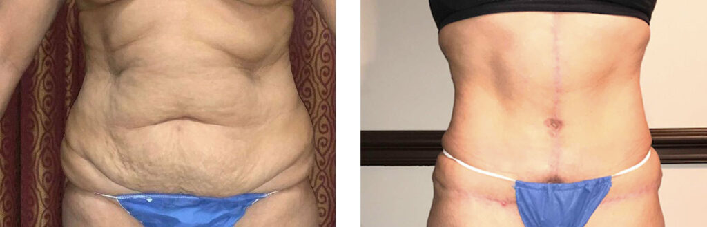 Abdominoplasty Fleur De Lis Patient 1