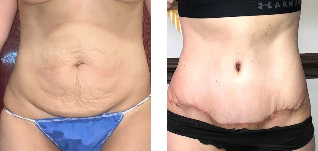 Cosmetic Surgery Tulsa | Tummy Tuck - Patient 1 - Front