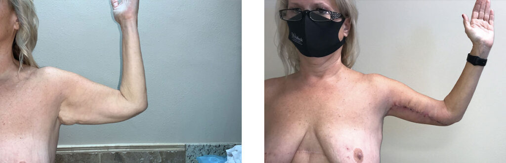 Brachioplasty Patient 5 Front Left
