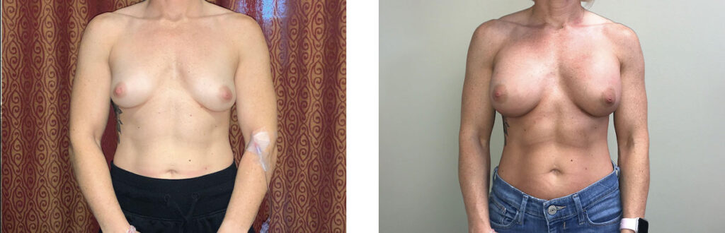Breast Augmentation Patient 12 Front