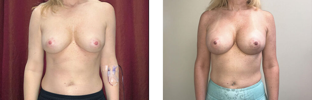 Breast Augmentation Patient 13 Front