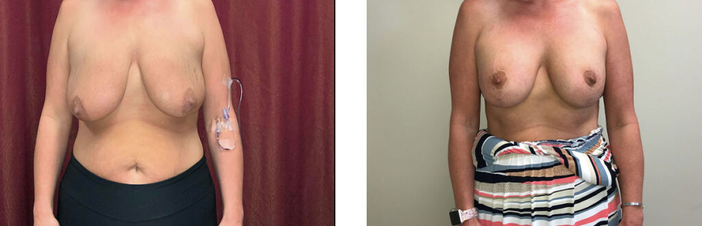 Breast Augmentation Patient 7 Front