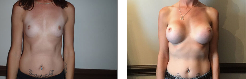 Breast Augmentation Patient 8 Front