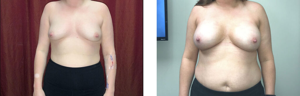 Breast Augmentation Patient 9 Front