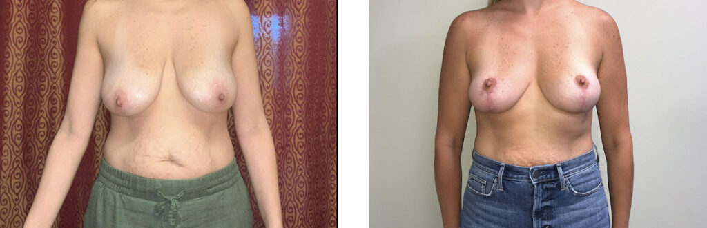 Breast Lift Patient 1 Front