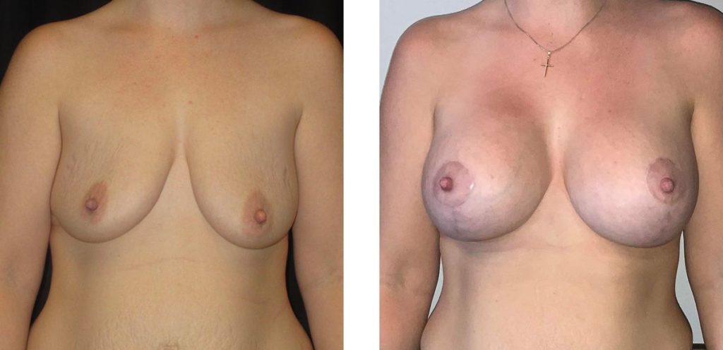 Cosmetic Surgery Tulsa | Breast Lift - Patient 3 - Front