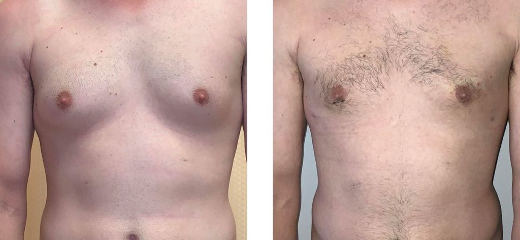 Cosmetic Surgery Tulsa | Gynecomastia - Patient 1 - Front