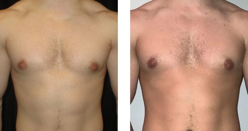 Cosmetic Surgery Tulsa | Gynecomastia - Patient 2 - Front