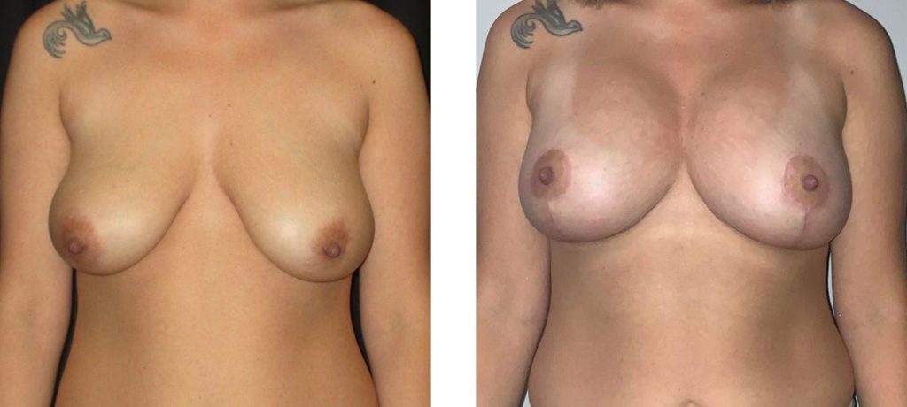 Cosmetic Surgery Tulsa | Breast Lift - Patient 8 - Front