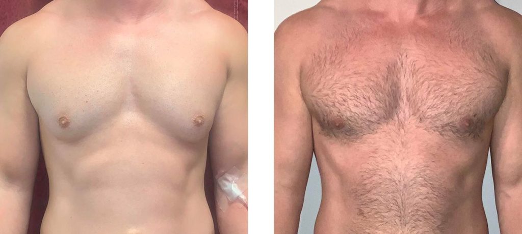 Cosmetic Surgery Tulsa | Gynecomastia - Patient 3 - Front