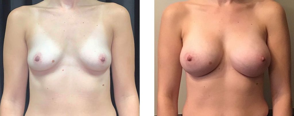 Cosmetic Surgery Tulsa | Breast Augmentation - Patient 2 - Front