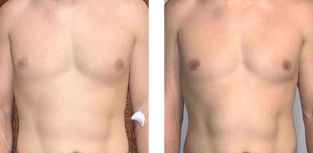 Cosmetic Surgery Tulsa | Gynecomastia - Patient 4 - Front