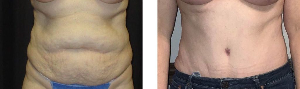 Cosmetic Surgery Tulsa | Tummy Tuck - Patient 3 - Front