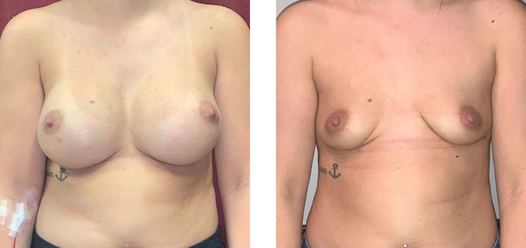 Cosmetic Surgery Tulsa | Explant - Patient 1 - Front