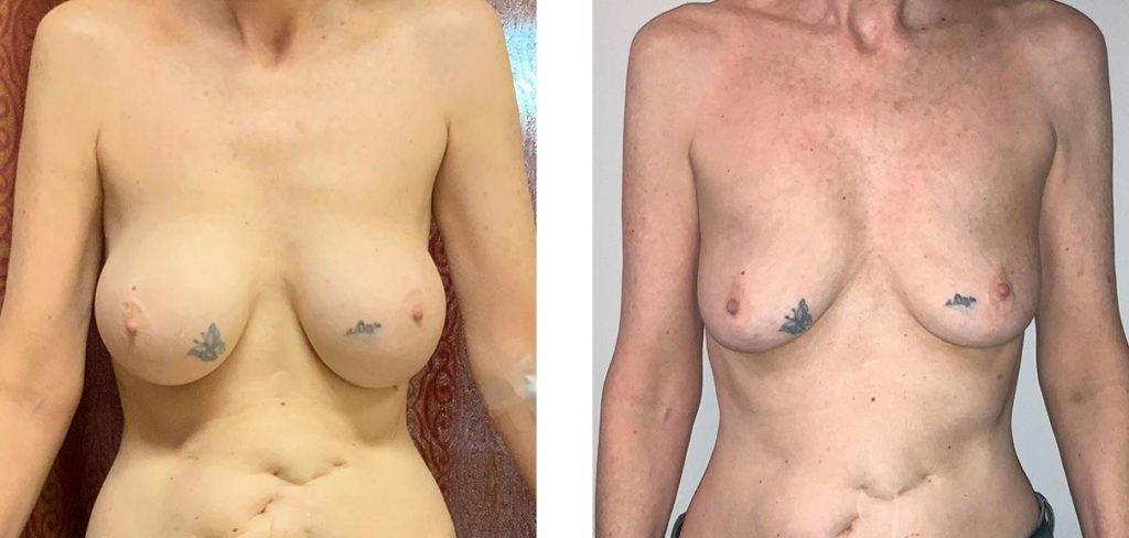Cosmetic Surgery Tulsa | Explant - Patient 2 - Front