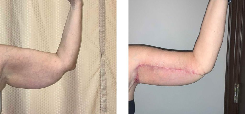Cosmetic Surgery Tulsa | Brachioplasty - Patient 1 - Left Front