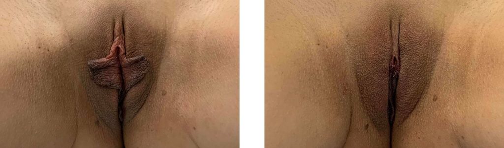 Cosmetic Surgery Tulsa | Labiaplasty - Patient 1 - 1