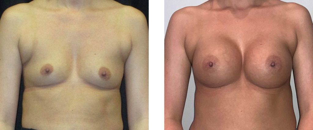 Cosmetic Surgery Tulsa | Breast Augmentation - Patient 6 - Front