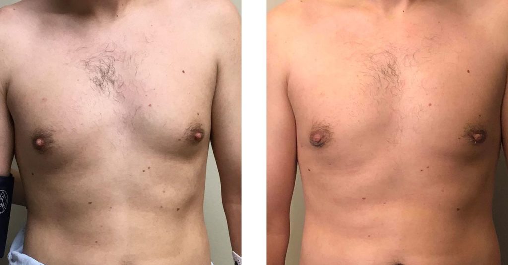 Cosmetic Surgery Tulsa | Gynecomastia - Patient 5 - Front