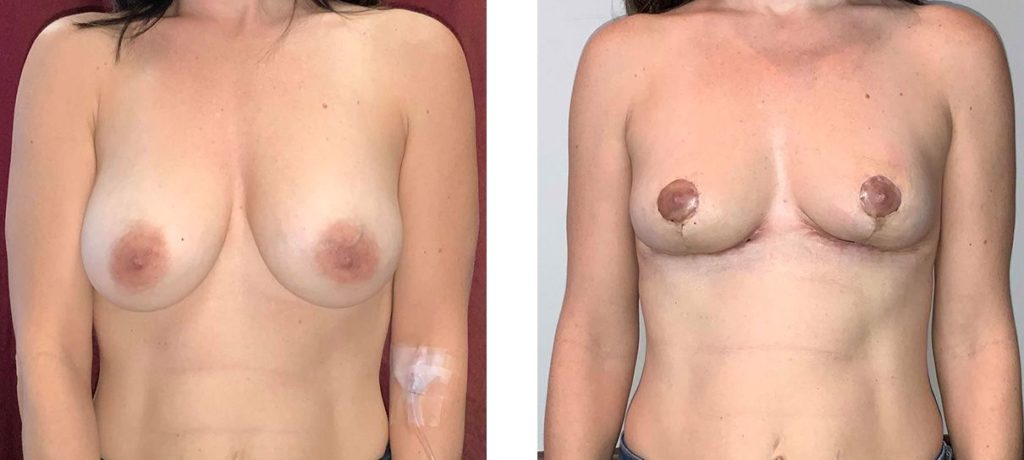 Cosmetic Surgery Tulsa | Explant - Patient 3 - Front