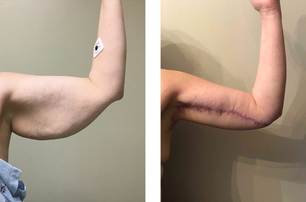 Cosmetic Surgery Tulsa | Stephanie B. - Left Front
