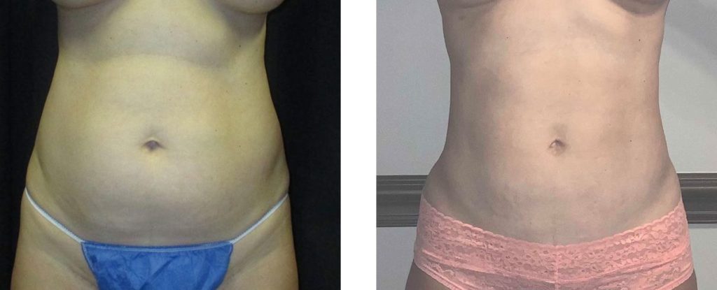 Cosmetic Surgery Tulsa | Liposuction - Patient 2 - Front