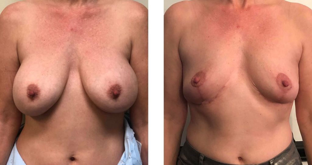 Cosmetic Surgery Tulsa | Explant - Patient 4 - Front