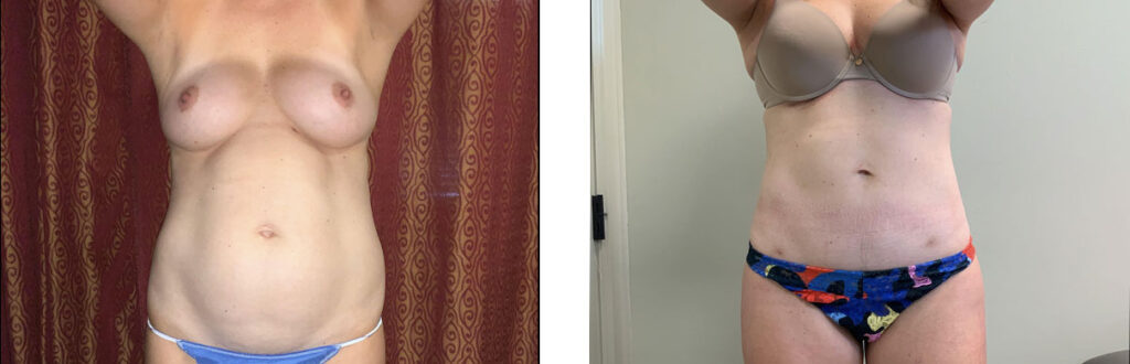 Liposuction Patient 3 Front