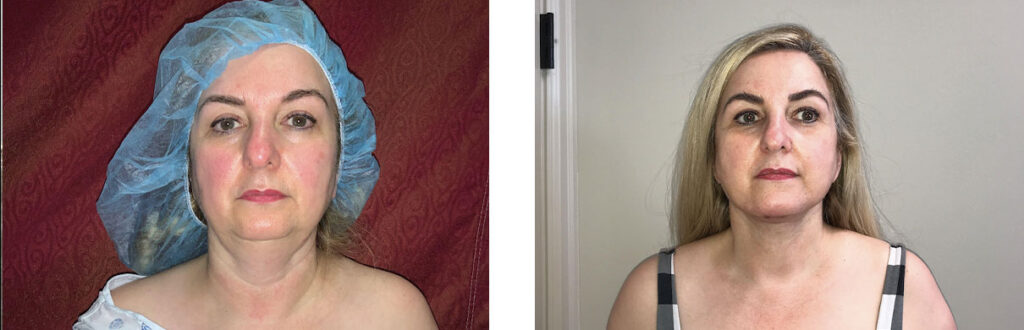 Liposuction Patient 4 Front