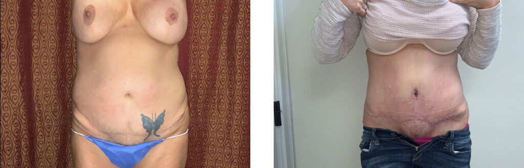 Liposuction Patient 5 Front