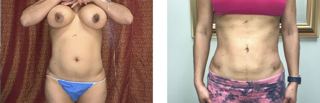Liposuction Patient 6 Front