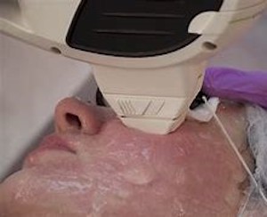 Tulsa Cosmetic Surgeon IPL Photofacial