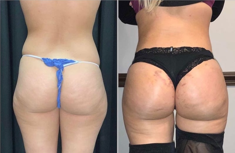 Tulsa Cosmetic Surgery Bbl 3