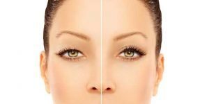 Tulsa Cosmetic Surgery Eyelid Surgery