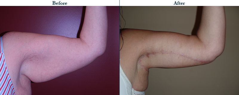 Tulsa Cosmetic Surgery Whitlock Brachioplasty Before After Web41
