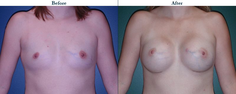 Tulsa Cosmetic Surgery Whitlock Breast Augmentation Before After Web10