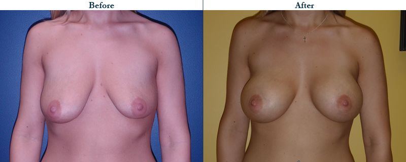 Tulsa Cosmetic Surgery Whitlock Breast Augmentation Before After Web11