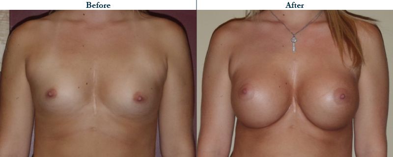 Tulsa Cosmetic Surgery Whitlock Breast Augmentation Before After Web12