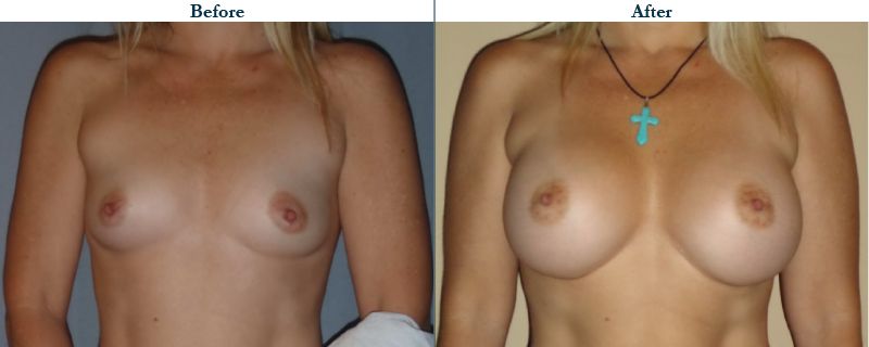 Tulsa Cosmetic Surgery Whitlock Breast Augmentation Before After Web13