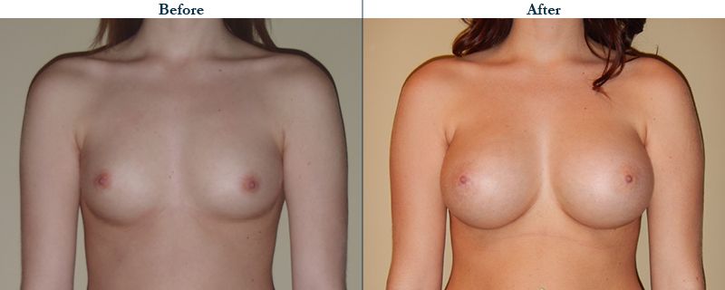 Tulsa Cosmetic Surgery Whitlock Breast Augmentation Before After Web15