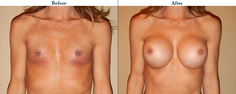 Tulsa Cosmetic Surgery Whitlock Breast Augmentation Before After Web17