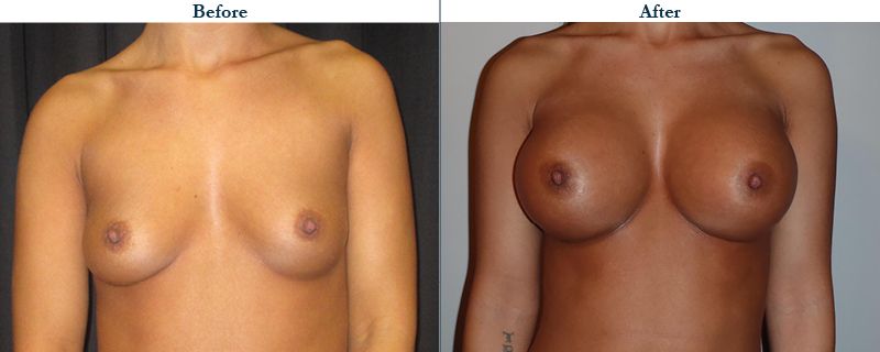 Tulsa Cosmetic Surgery Whitlock Breast Augmentation Before After Web19