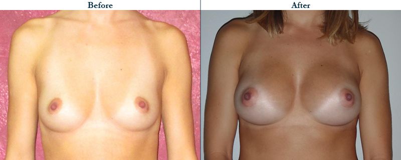 Tulsa Cosmetic Surgery Whitlock Breast Augmentation Before After Web20