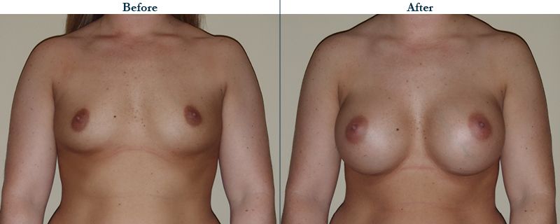 Tulsa Cosmetic Surgery Whitlock Breast Augmentation Before After Web3