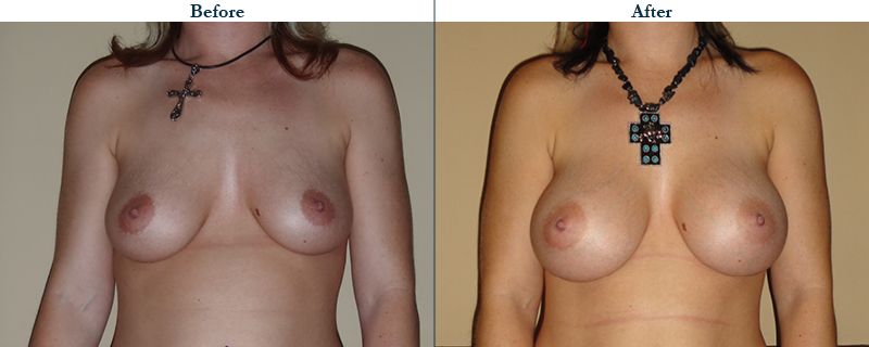 Tulsa Cosmetic Surgery Whitlock Breast Augmentation Before After Web4