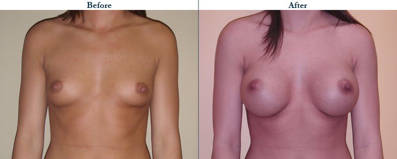 Tulsa Cosmetic Surgery Whitlock Breast Augmentation Before After Web5