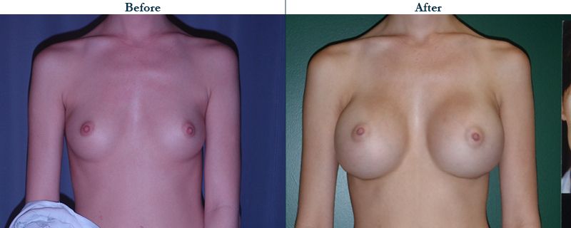 Tulsa Cosmetic Surgery Whitlock Breast Augmentation Before After Web6